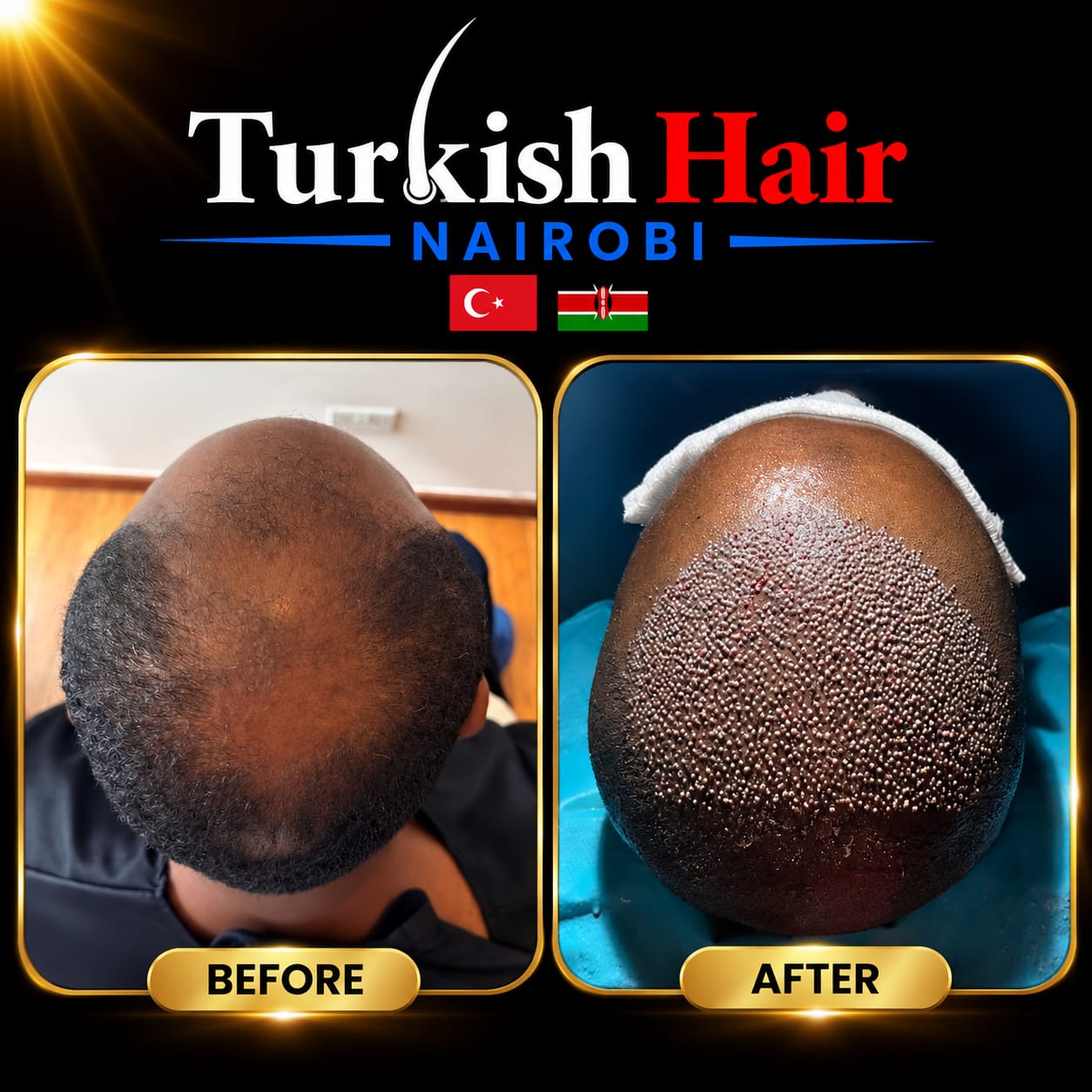 Turkish Hair Nairobi Case 10